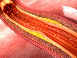Атеросклероз у пожилых. Причины возникновения, терапия